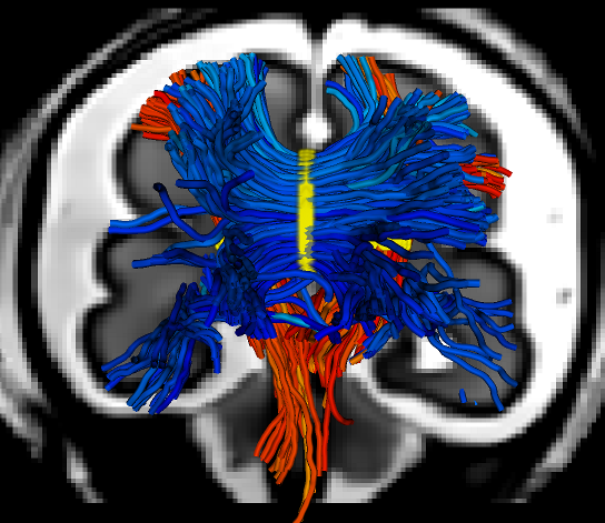 Coronal view of the tractography