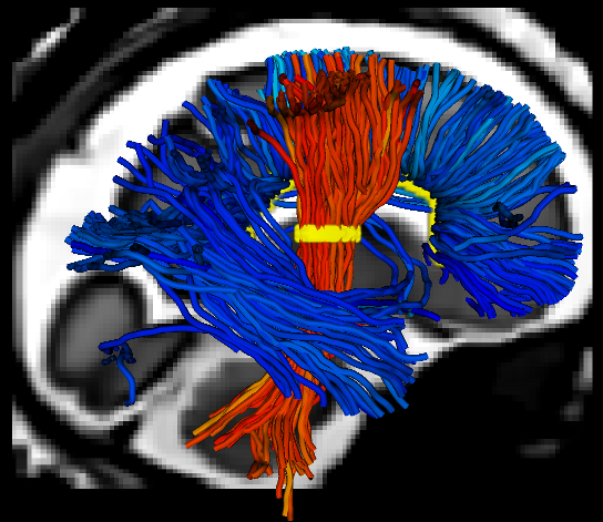 Sagittal view of the tractography